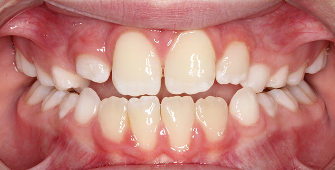 After plate from treatment for right side cross bite with midline shift